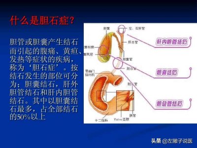 ​胆结石吃什么东西可以淡化了 胆结石吃什么能化解